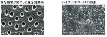 象牙細管が開口した象牙質表面 ハイブリッドコートⅡの効果