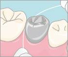 フロスでコンタクトと歯間乳頭部の余剰セメントを絡め取る